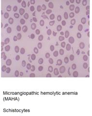 Histiocytic Neoplasms Bleeding Disorders And Coagulation Disorders