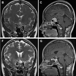 Tuberculum sellae meningioma (WHO grade I). (A–D) Preoperative MRI ...