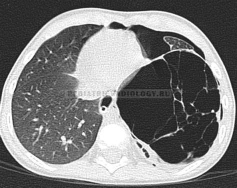 pleuropulmonary_blastoma_CT_axial - Лучевая диагностика в педиатрии