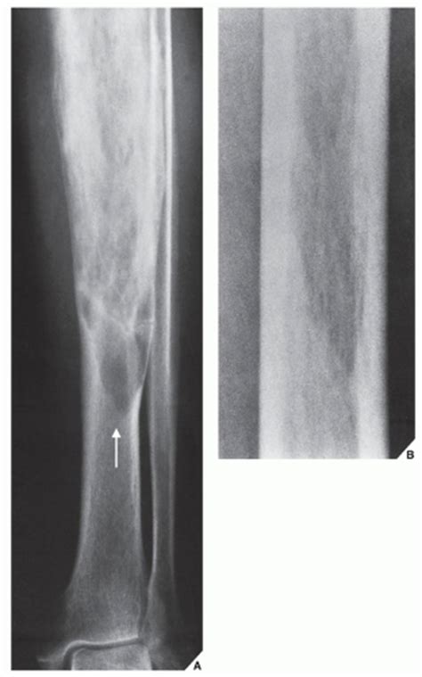 Paget Disease Radiology Key