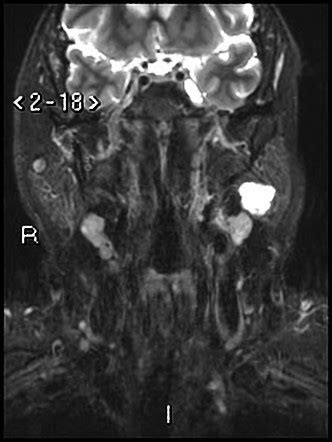 Pleomorphic Adenoma Parotid Gland Radiology Case Radiopaedia Org