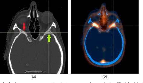 Figure 1 From The Value Of SSTR2 Receptor Targeted PET CT In Proton