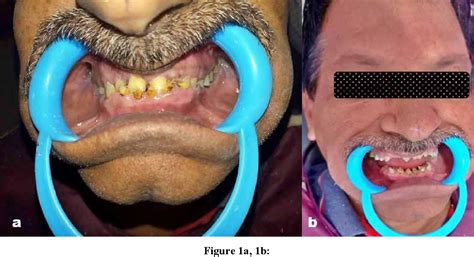 Full Mouth Rehabilitation Of A Patient With Uneven Occlusal Plane And