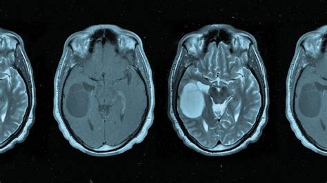 Oligodendroglioma: Symptoms, causes, and treatment