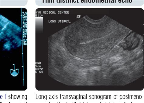 Figure 2 From The Role Of Transvaginal Ultrasound Or Endometrial Biopsy