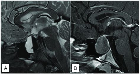 Sagittal Pre Operative T2 A And T1 B With Gadolinium Mr Download Scientific Diagram