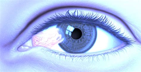 Dipyridamole Eye Drops for Pterygium and Pinguecula - Moshe Rogosnitzky