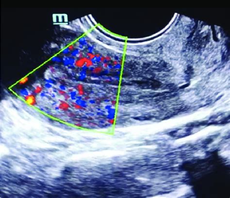 Endometrial Vascularity In 2d Ultrasound With Color Doppler Download