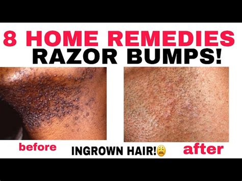 Best Remedy For Razor Bumps