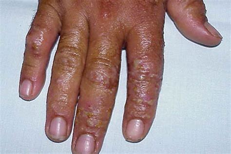 Dyshidrotic Dermatitis Symptoms Causes Diagnosis And Treatment