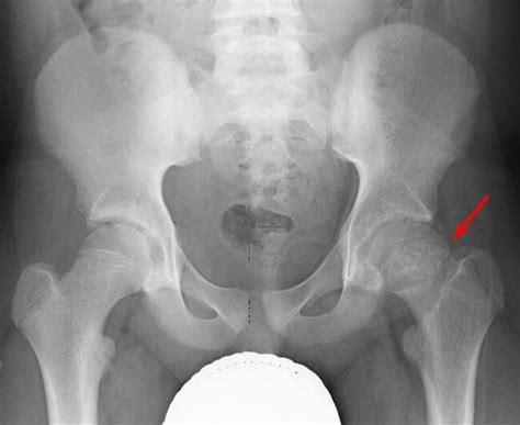 X Ray Of Scfe Mri Pelvis Pediatrics