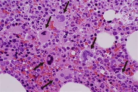 1 Bone Marrow Hematopoietic System 3 Idiopathic Thrombocytopenic