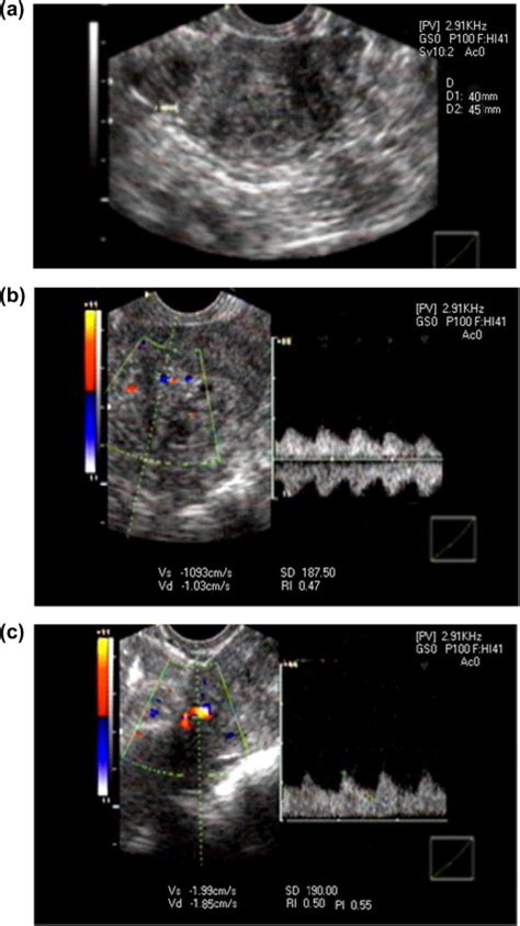 A Transvaginal Ultrasound Examination Of The Uterus Showed Grossly