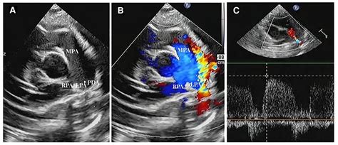 Frontiers Echocardiographic Parameters Predicting Spontaneous Closure