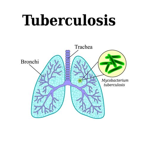 Tuberculosis Enfermedad Pulmonar Bacilo De Tub Rculo Ejemplo Del Vector