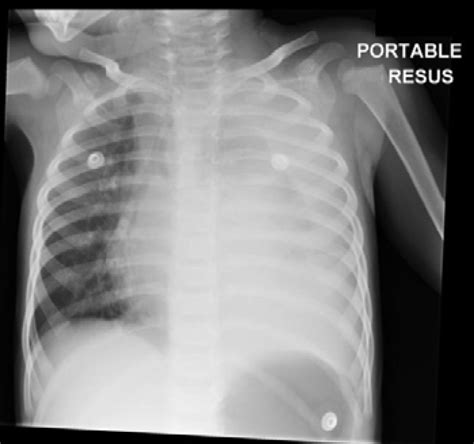 Community Acquired Pneumonia In Children The Bmj