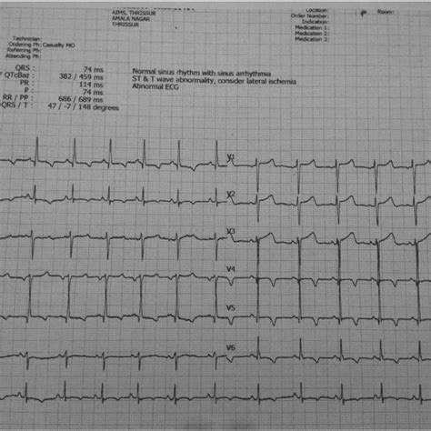 Tall T wave V1. Broad upright T wave V1>V6 with subtle septal (V1-V2 ...