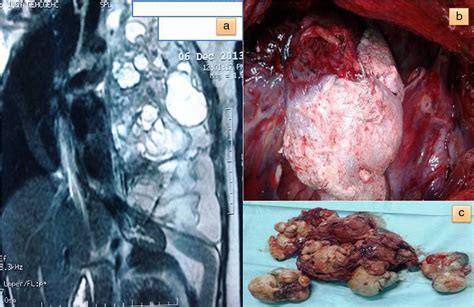 Giant Teratoma Presenting With Pregnancy And Causing Respiratory