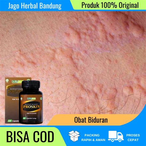 Jual Obat Biduran, Obat Biduran Alergi, Obat Biduran Apotek, Obat Biduran Anak Anak, Obat ...