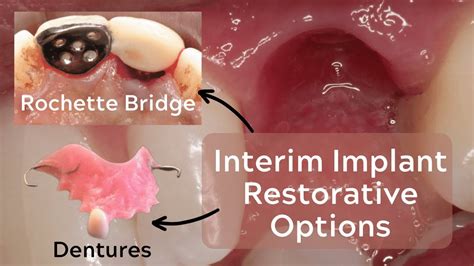 Rochette Bridges And Provisional Prostheses For Implants PDP145 YouTube