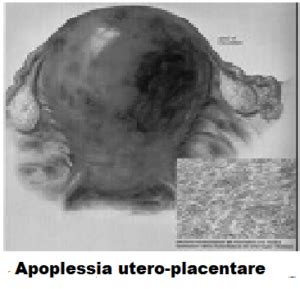 Distacco Intempestivo Di Placenta Fertilitycenter