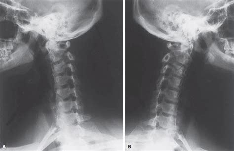 Right And Left Posterior Oblique C Spine Diagram Quizlet