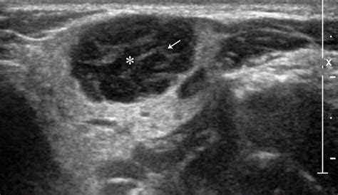 Parotid Gland Swelling Ultrasound