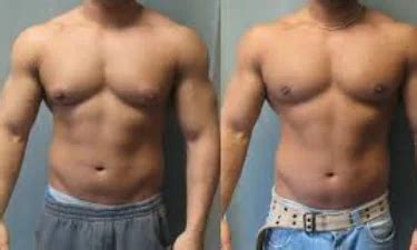 Gynecomastia Surgery in Surat | ID: 8963244130