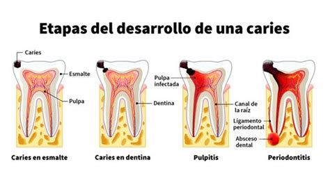 Cuánto tiempo puedo estar sin tratar una caries Clinica Dental Ribera