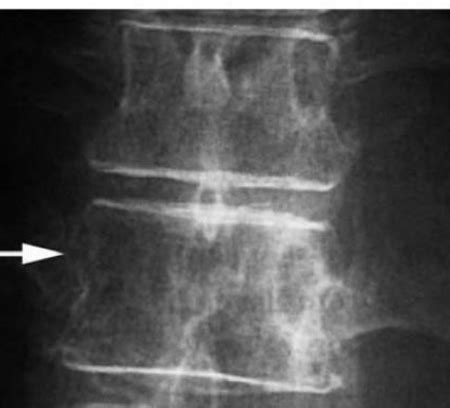 Vertebral pedicle involvement in skeletal metastasis: Plain Radiograph ...