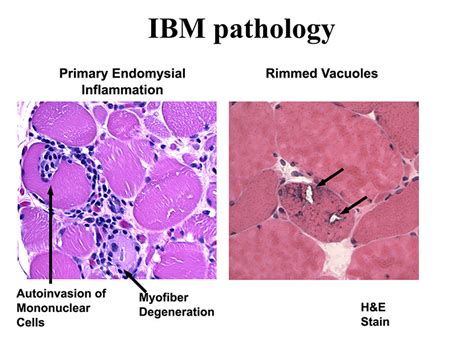 muscle biopsy cure ibm
