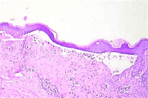 Skin Biopsy Showing Subepidermal Blister H And E ×100 Download Scientific Diagram