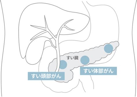 すい臓がんリスク検査キット Sugume