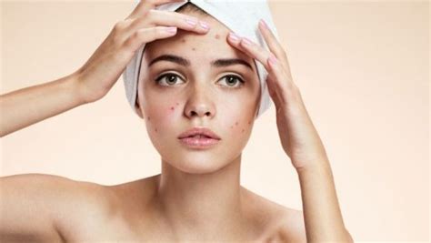 Rutinas Del Cuidado De La Piel Con Acne Belleza Y Alma