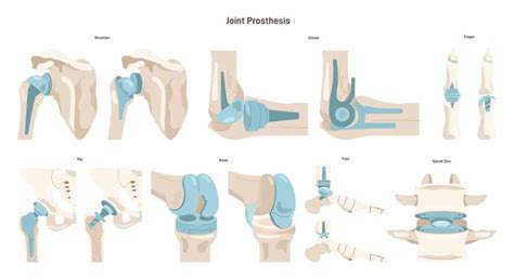 total joint replacement heiden orthopedics