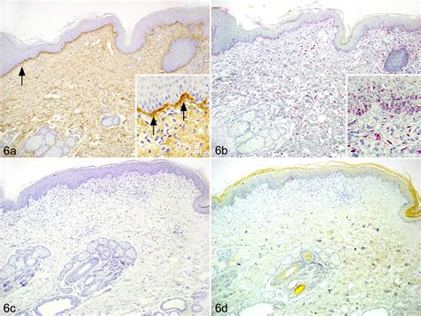 Expression Of Periostin In Normal Atopic And Nonatopic Chronically