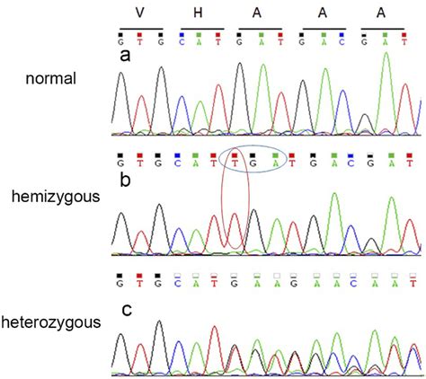 Sequencing Results Of Emd Mutation A Image A Shows Results For A