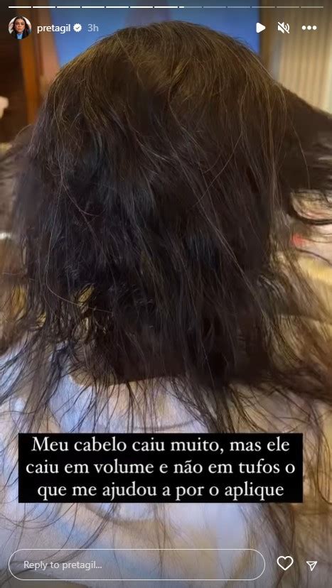 Preta Gil Tira O Aplique E Mostra Cabelo Ap S A Quimioterapia Caiu Muito