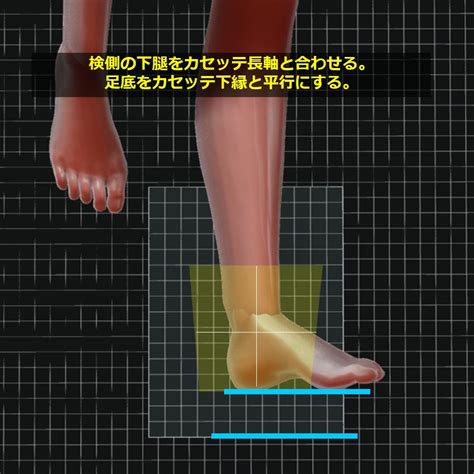 Anthonsen View Method Subtalar Joint Axial Oblique