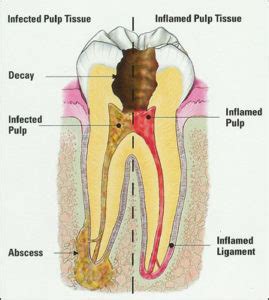 Non Surgical Root Canal Therapy Platte Valley Endodontics