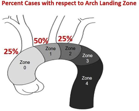 Hybrid Aortic Arch Debranching And TEVAR Is Safe In A Private