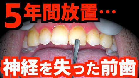 【歯科恐怖症】歯医者が怖くて5年間放置した結果神経を失った前歯の根を治療【第2回】 Youtube