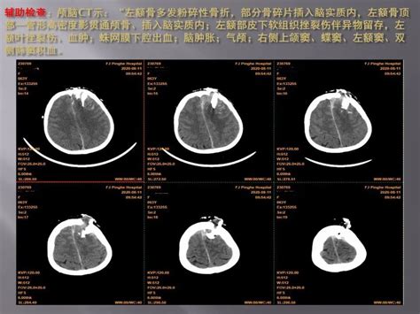 监测有道丨重型开放性颅脑损伤内异物个例报告——颅脑创伤 神经重症周刊（第204期） 脑医汇 神外资讯 神介资讯