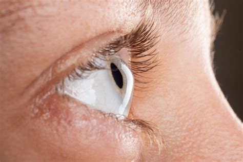 What Are The Effects And Treatment Of Keratoconus