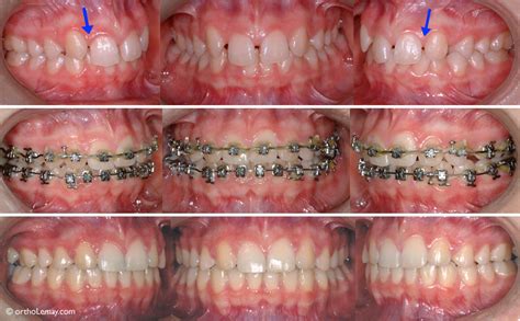 Missing lateral incisors – anodontia | Bücco