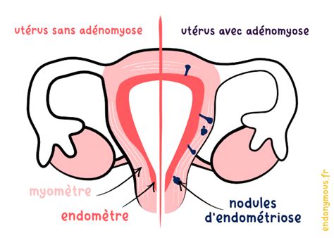 Les différences entre endométriose et adénomyose Endonymous