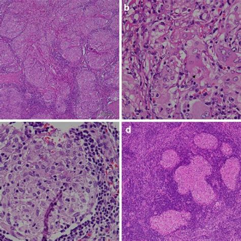 Histopathological Findings Of Case 2 A He Staining Of The Spleen With Download Scientific