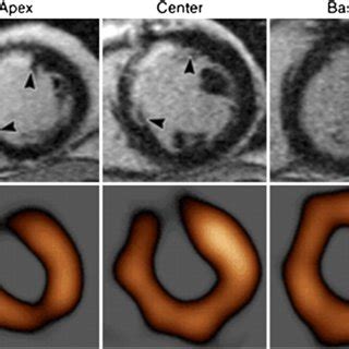 Asymmetric Hypertrophic Cardiomyopathy In A Years Old Man Showed