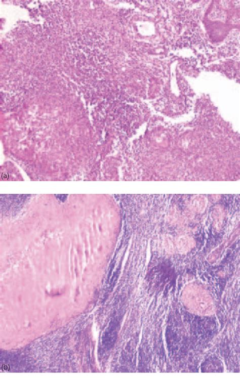 Figure From Coexistence Of Tuberculosis Verrucosa Cutis With