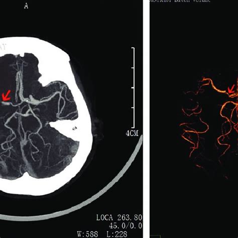 Magnetic Resonance Angiography Showed Occlusion Of The Right Internal